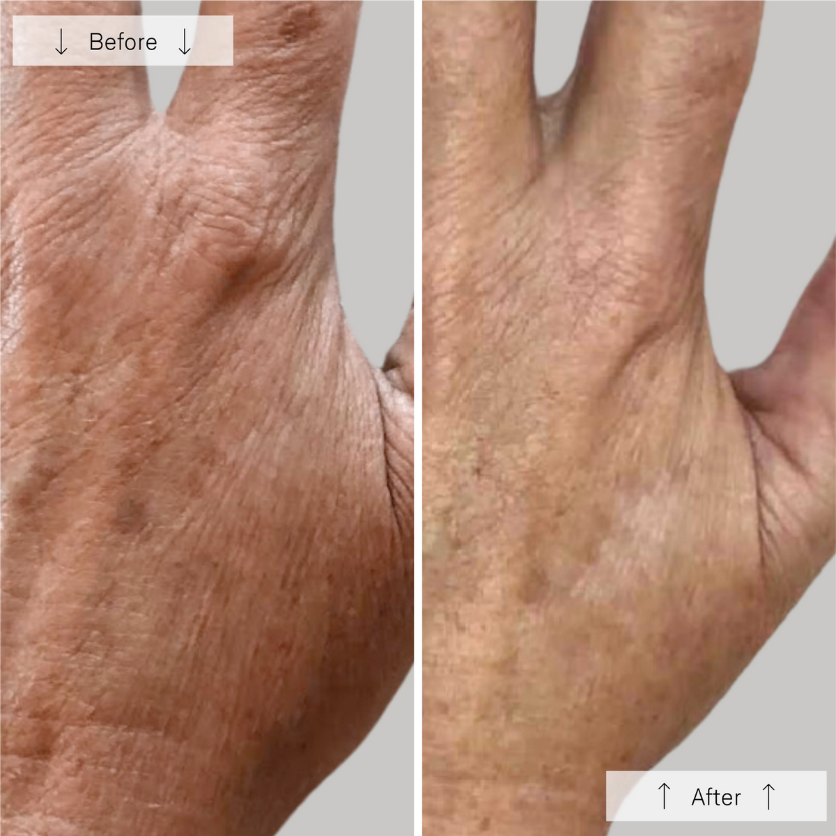 Omnilux Clear + Contour Glove Bundle
